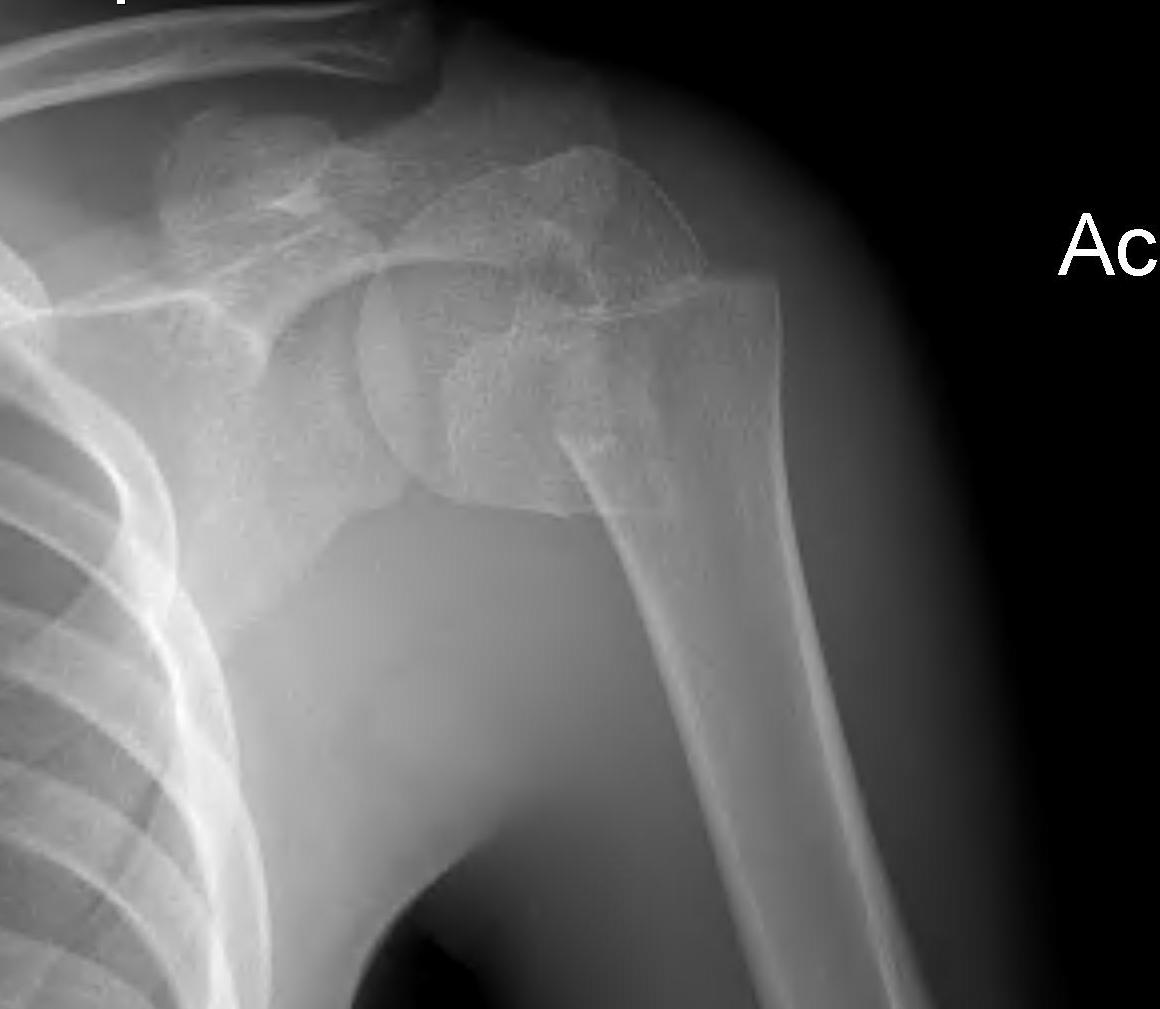 Pediatric Proximal Humeral Fracture Remodelling Pre